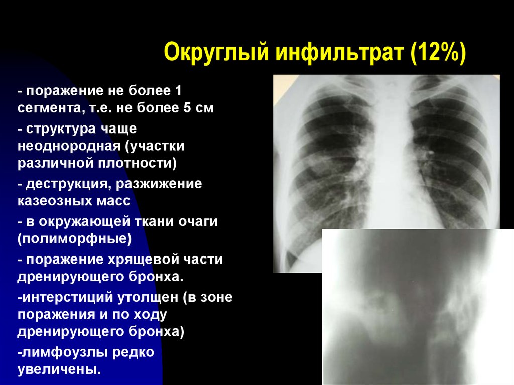 Инфильтрат это. Инфекционный инфильтрат. Рентгенодиагностика туберкулеза.