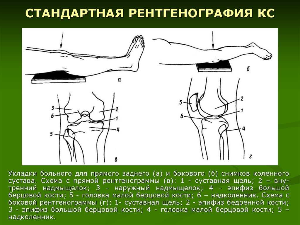 Опухоли коленного сустава схема