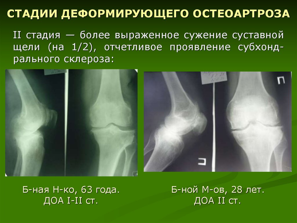 Деформация коленного сустава при артрозе фото