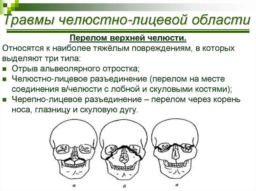 Переломы костей верхней челюсти. Классификация переломов челюстей лицевого скелета.. Клинические проявления переломов челюсти.