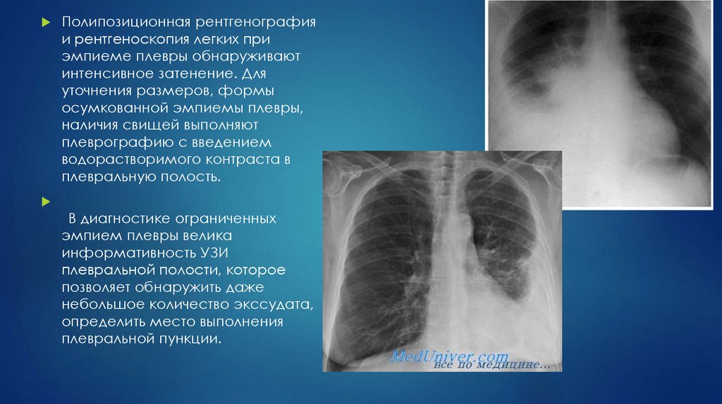 Экссудативный плеврит рентгенологическая картина