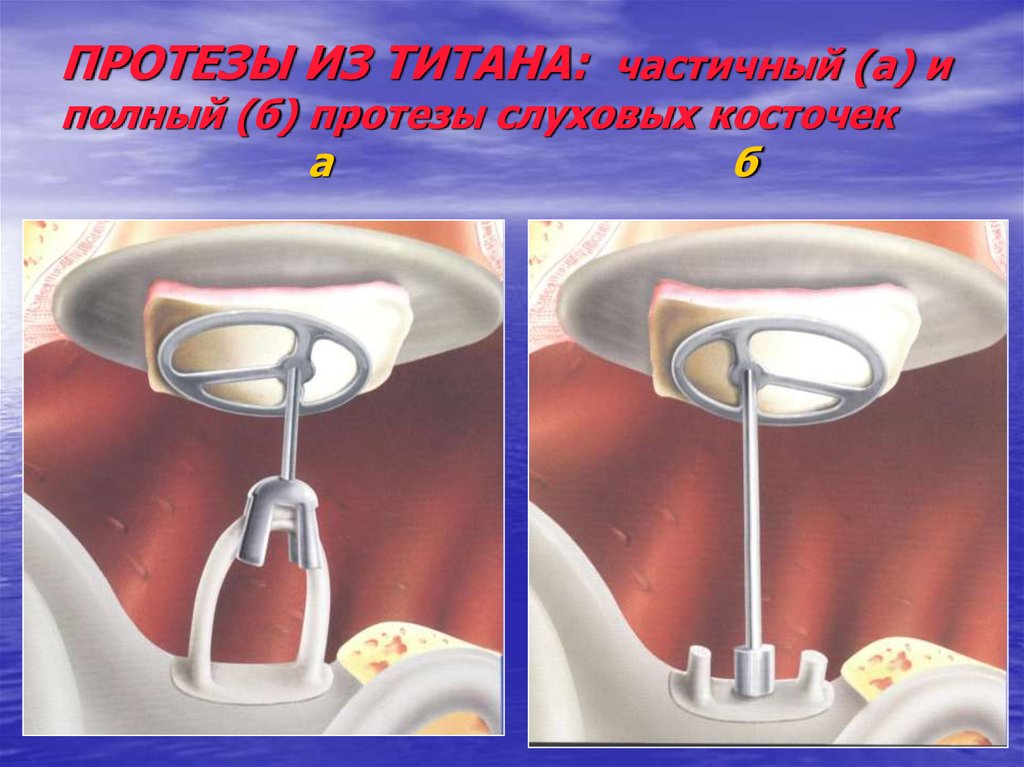 Стапедопластика. Протез слуховых косточек Курц. Тимпанопластика уха протез слуховых косточек. Титановый протез слуховых косточек. Тимпанопластика протезы.