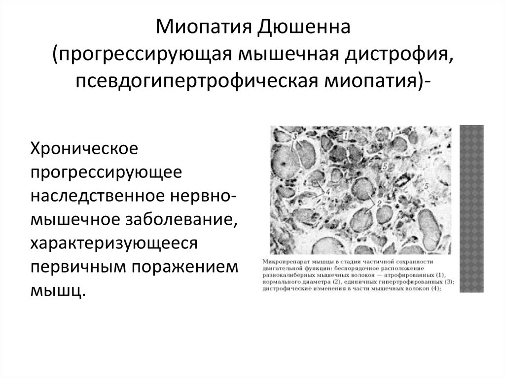 Миопатия что это. Миодистрофия Дюшенна патогенез. Миопатия Дюшенна этиология и патогенез. Дистрофия Дюшенна этиология. Псевдогипертрофическая миопатия.