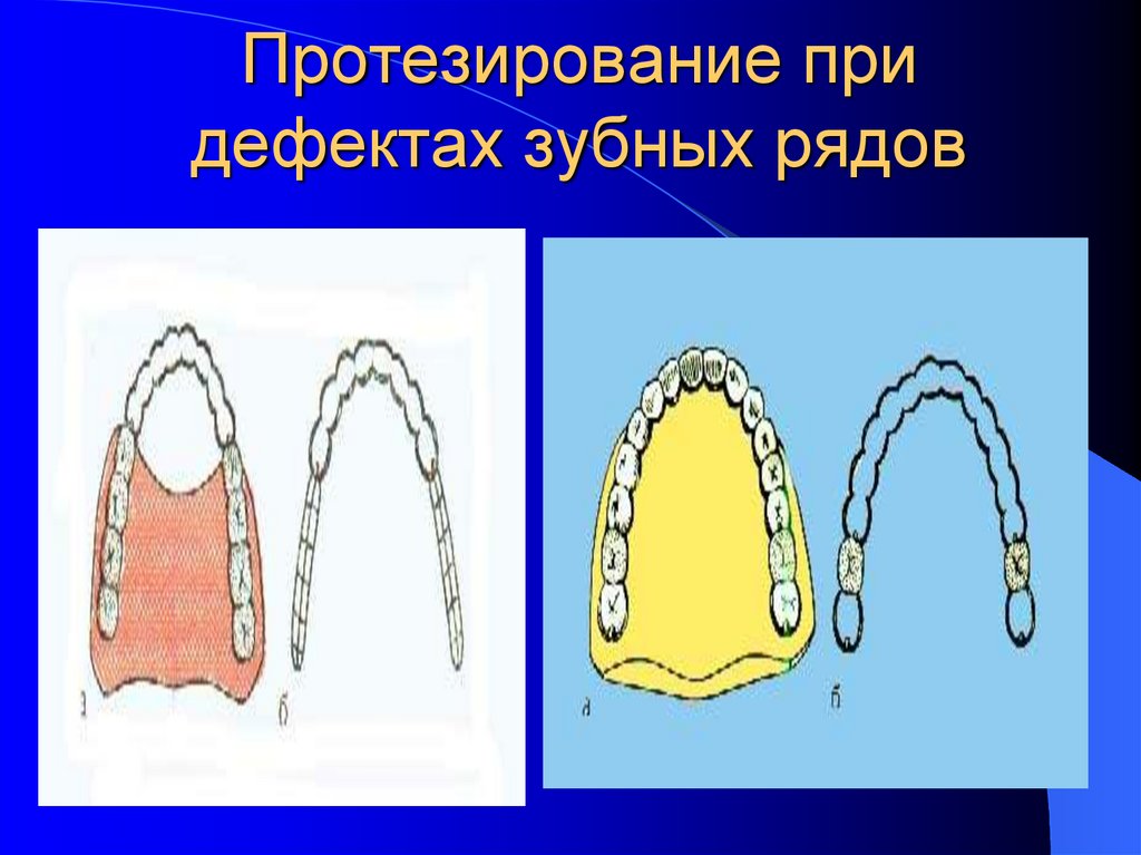 Клиническая картина при дефектах зубных рядов