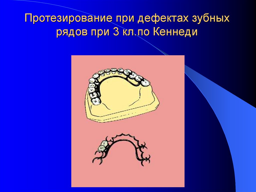 Дефекты зубных рядов. Концевой дефект зубного ряда. Дефекты зубных рядов по Кеннеди. Шины по Кеннеди.