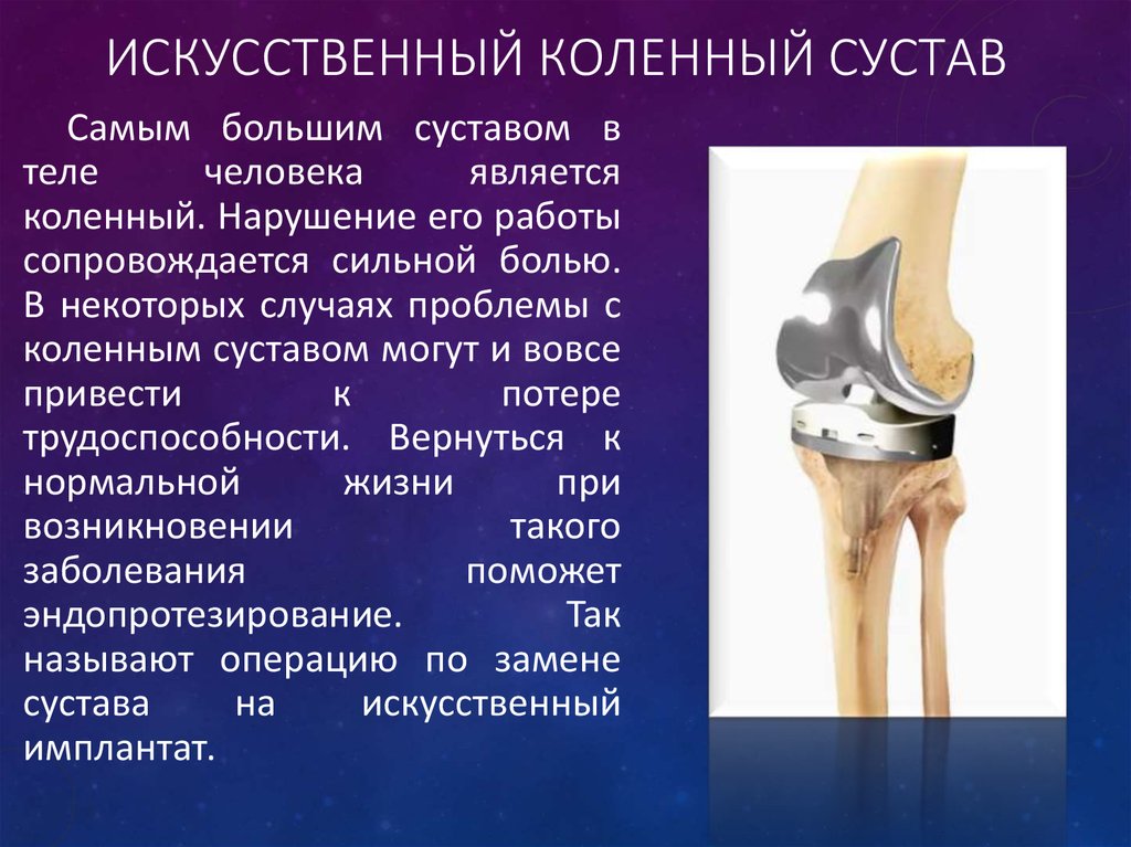 Искусственный сустав. Коленный сустав суставы. Функции коленного сустава человека анатомия.
