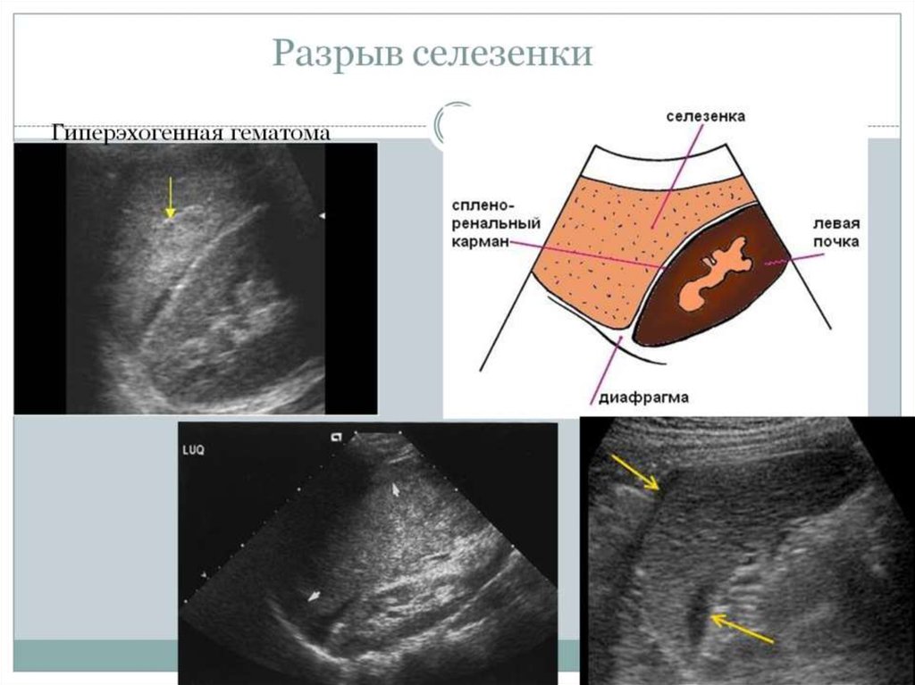 Жидкость в селезенке. Гепатома селезенки УЗИ. Подкапсульный разрыв селезенки на УЗИ. УЗИ картина травмы селезенки. Гематома селезенки на УЗИ.