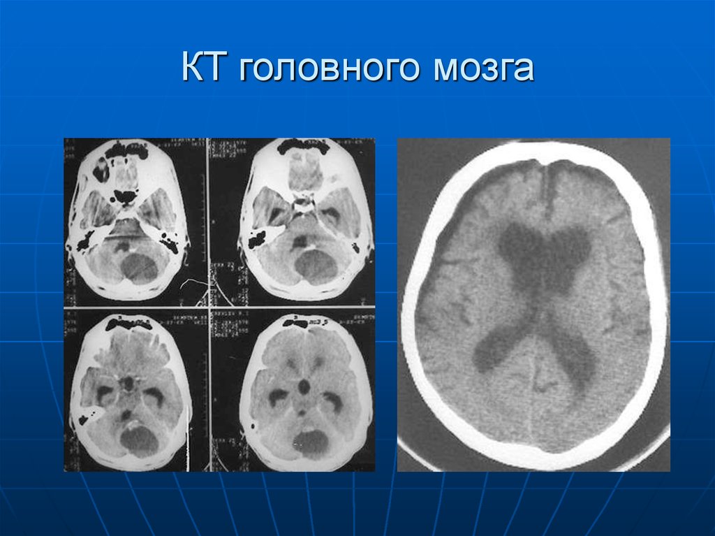 Диагностика головного. Кт головного мозга. Кт мозга. Компьютерная томограмма головного мозга. Кт головы.