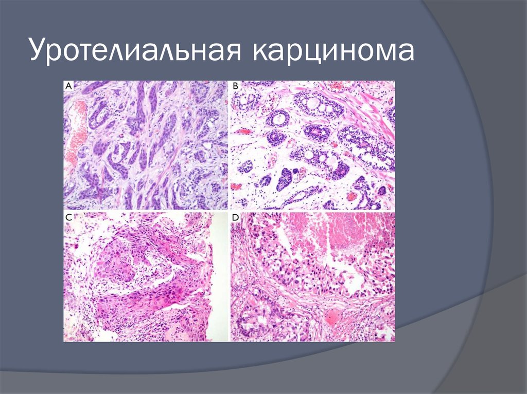 Карцинома low grade мочевого. Папиллярная карцинома гистология. Уротелиальная карцинома мочевого пузыря микропрепарат. Переходно клеточная карцинома почки. Переходно клеточная карцинома мочевого пузыря гистология.