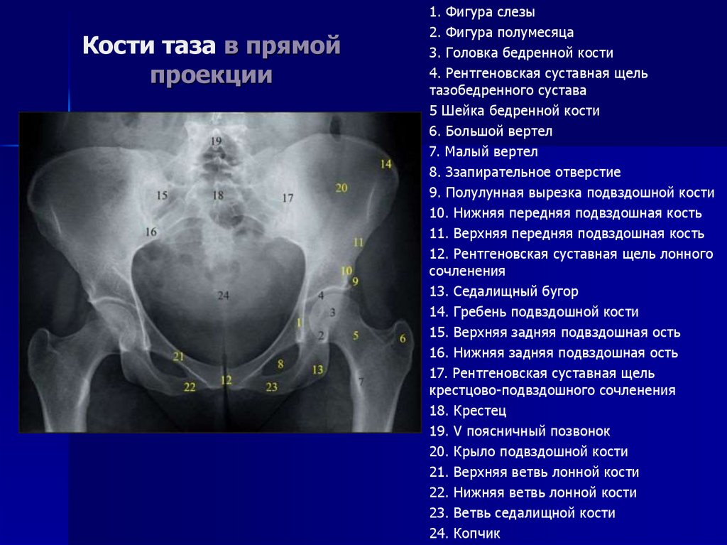 Правая лонная кость. Анатомия подвздошной кости рентген. Подвздошная кость рентгенанатомия. Рентгенанатомия комтей таза. Передней верхней ости подвздошной кости.