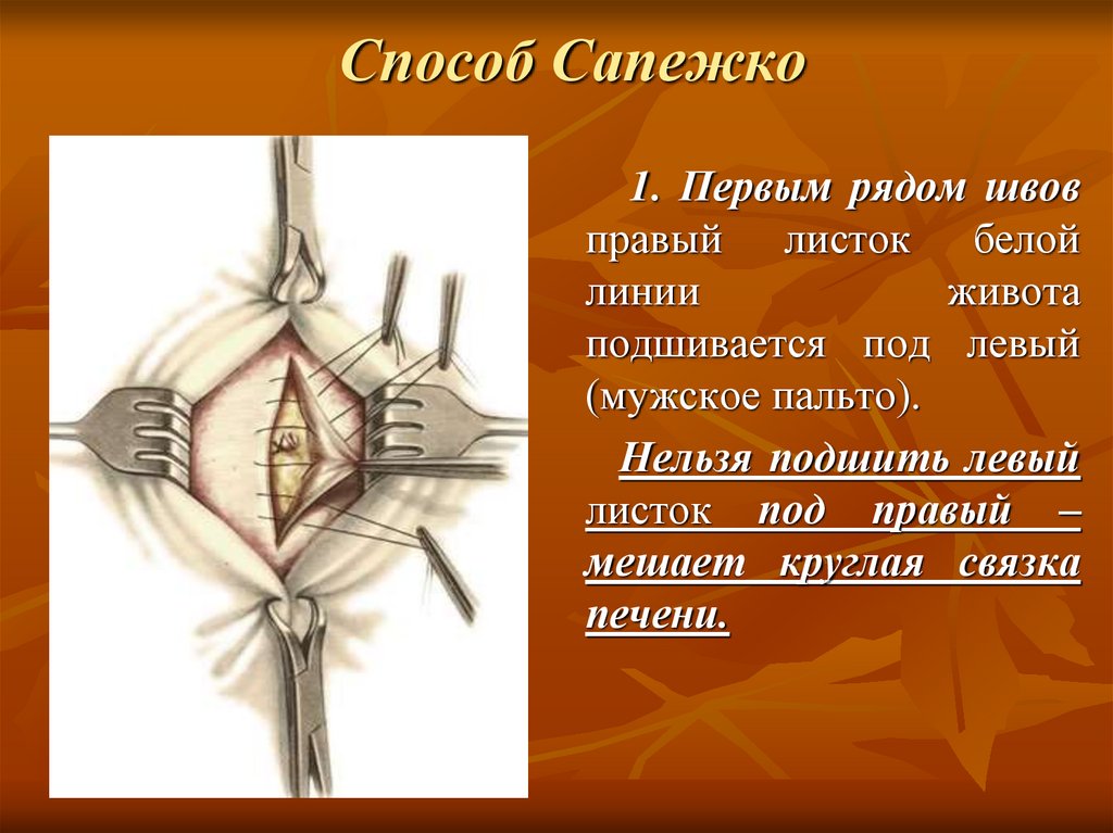 Герниопластика пупочной грыжи