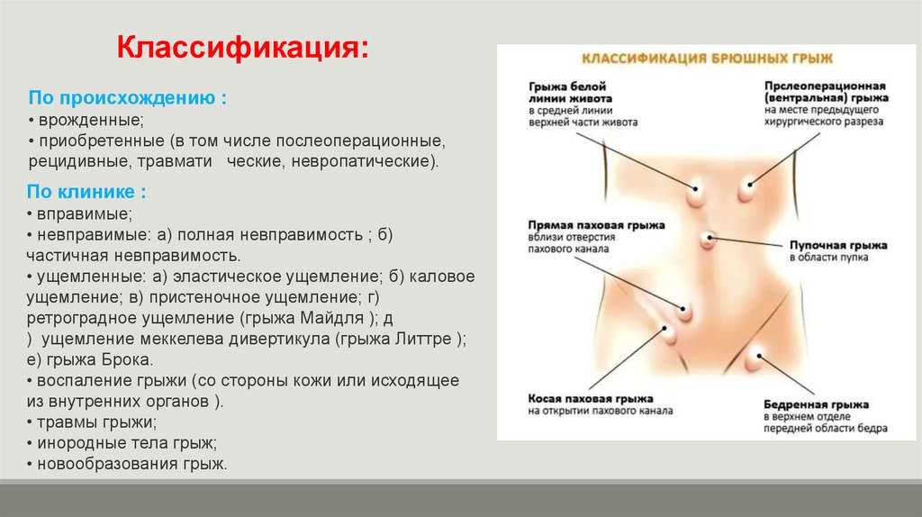 Симптомы грыжи живота