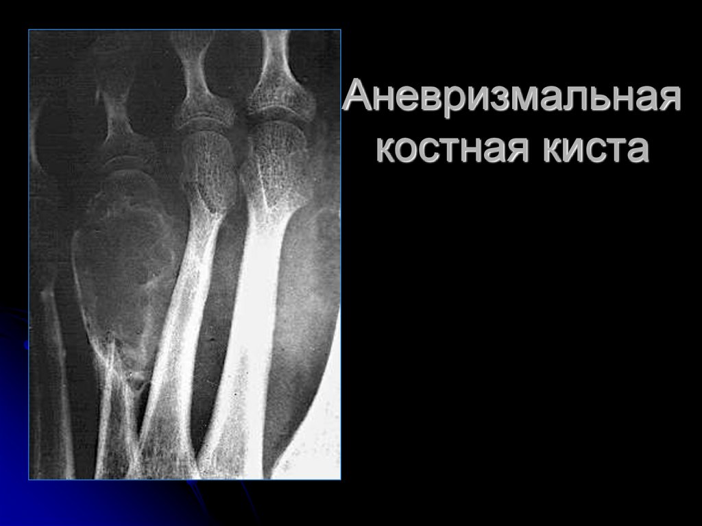 Костная киста. Аневризматическая костная киста пястной кости. Костная киста плечевой кости кт. Аневризмальная киста кости кт. Аневризматическая костная киста пальца.