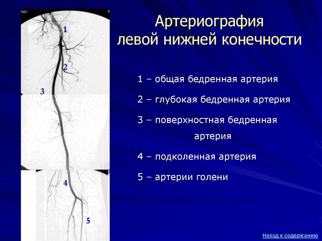 Глубокая бедренная. Артерии голени кт ангиография. Ангиография подколенной артерии. Сосуды голени кт анатомия. Артерии нижних конечностей кт анатомия.