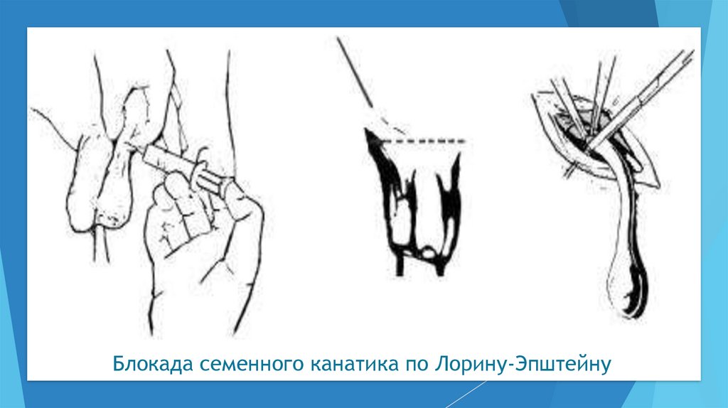 Блокада кисти. Новокаиновая блокада по Лорин-Эпштейну. Блокада семенного канатика. Блокада семенного канатика по Лорин-Эпштейну техника. Новокаиновая блокада семенного канатика.