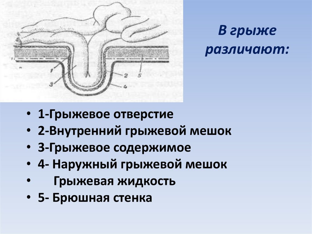 Грыжевой мешок