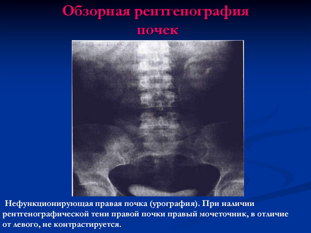 Рентгенография почек. Подковообразная почка рентген урография. Обзорная рентгенография почек. Аномалии развития почек рентген. Обзорная рентгенограмма почек и мочевых путей.