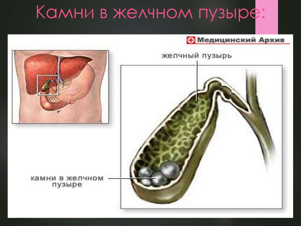 Полипы в желчном пузыре симптомы