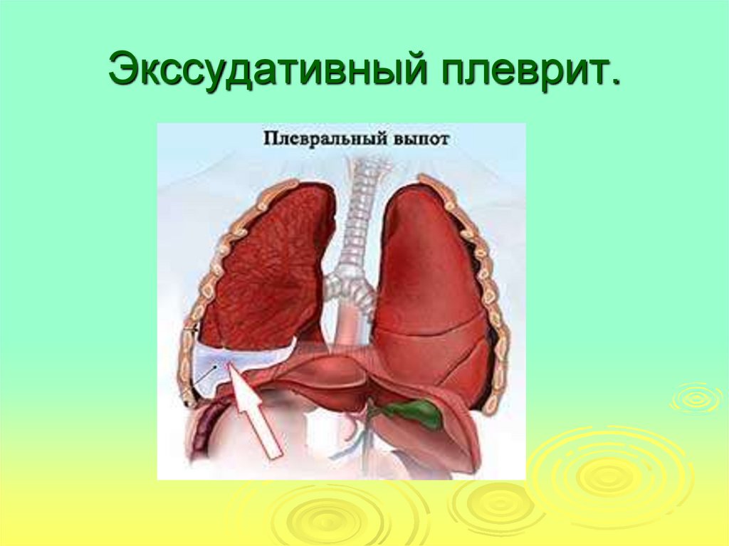 Плеврит что это. Экссудативный плеврит. Экссудативный плеврит легких. Выпотной плеврит клиника.