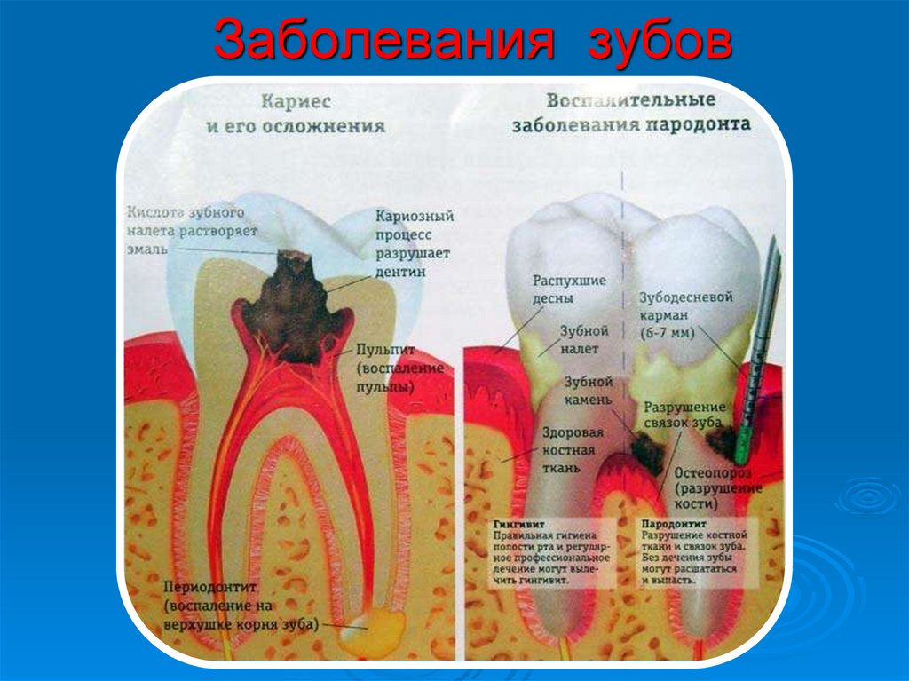 Зубные боли какие. Строение зуба кариес пульпит. Болезни зубов пародонтит кариес. Кариозные поражения зубов кариес. Молочный зуб строение кариес.