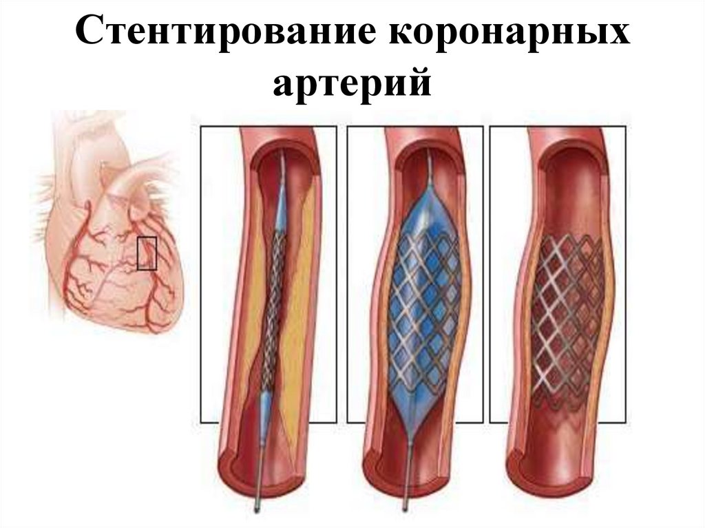 После стентирования