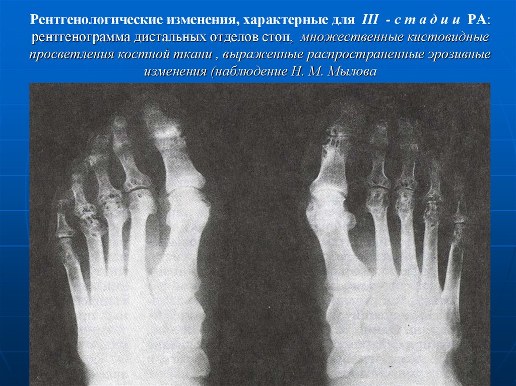 Рентген стопы в двух проекциях фото с описанием