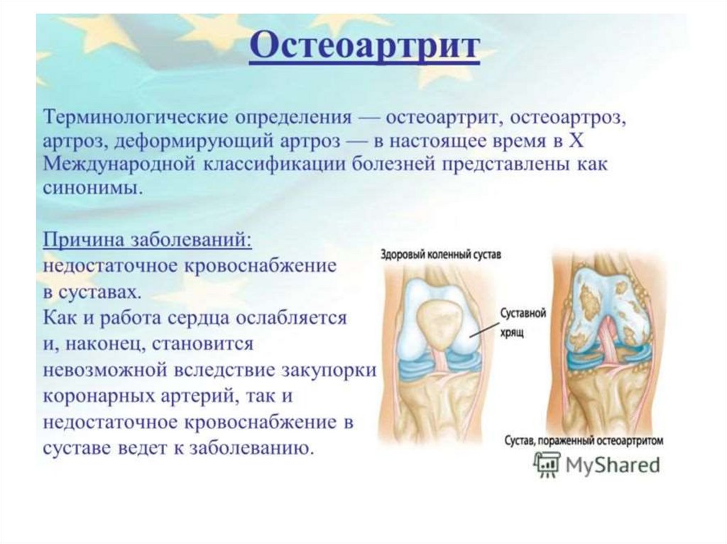 Лечение симптом сустав. Остеоартрит и остеоартроз. Поражение суставов при деформирующем остеоартрозе. Локализация остеоартроза.