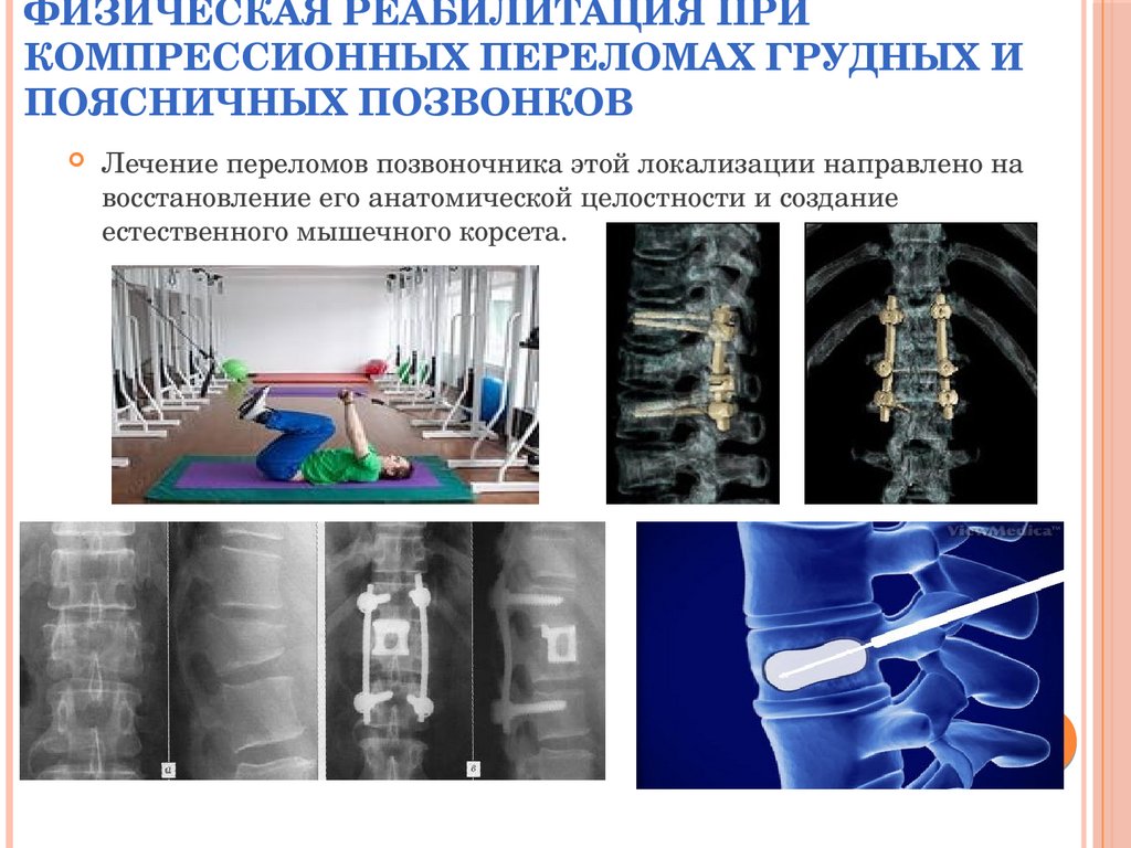 Периневральная киста позвоночника s2. ГАЗ В телах позвонков. Воздух в телах позвонков. Помечанме позвонков маркером.