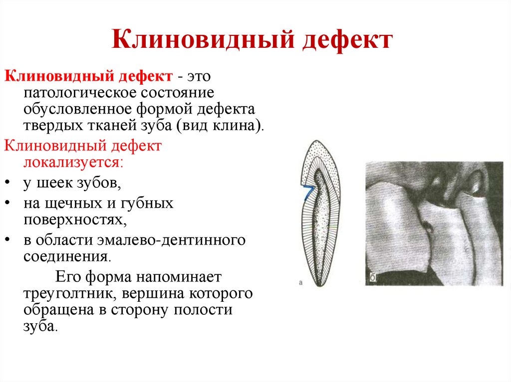 Клиновидный дефект стоматологическая карта