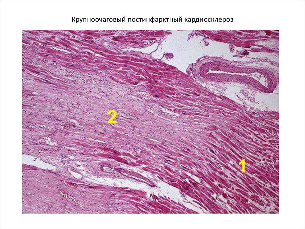 Постинфарктный кардиосклероз что это. Крупноочаговый постинфарктный кардиосклероз. Крупноочаговый кардиосклероз микропрепарат. Крупноочаговый постинфарктный кардиосклероз микропрепарат. Постинфарктный кардиосклероз микропрепарат.