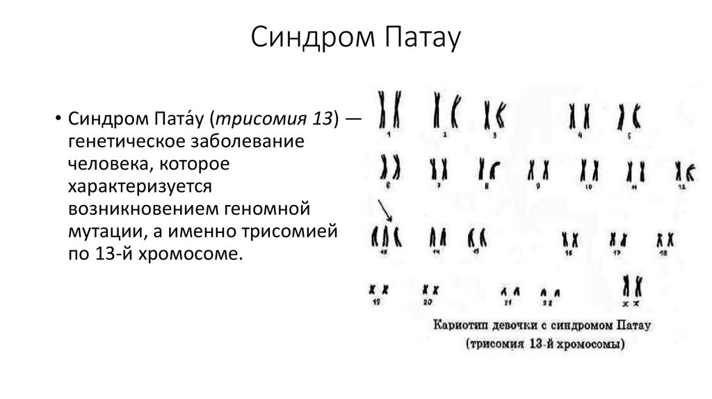 Синдром тельце. Синдром Патау трисомия по 13 хромосоме. Синдром Патау хромосомный набор. Синдром Патау набор хромосом. Синдром Патау кариотип.