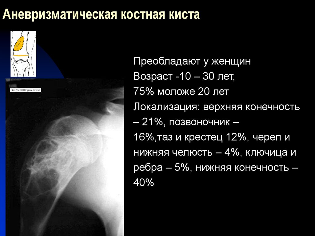 Операция кисты кости. Аневризматическая костная киста рентген. Аневризматическая костная киста плечевой кости кт. Простая костная киста бедренной кости кт. Солитарная киста бедренной кости рентген.