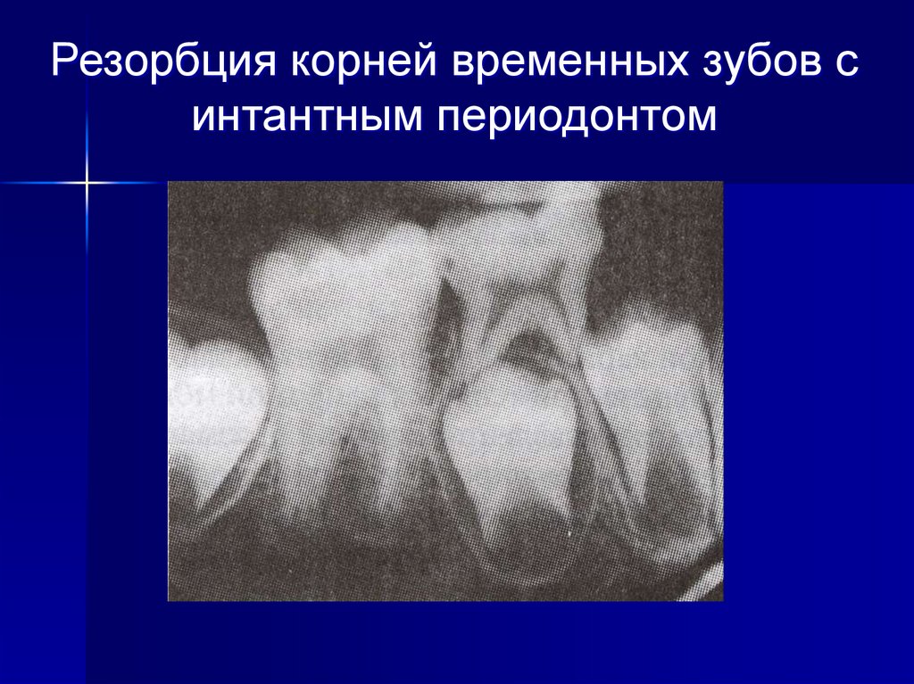 Резорбция это. Резорбция корней временных зубов. Физиологическая резорбция корней временных зубов. Резорбция корня зуба апикальной.