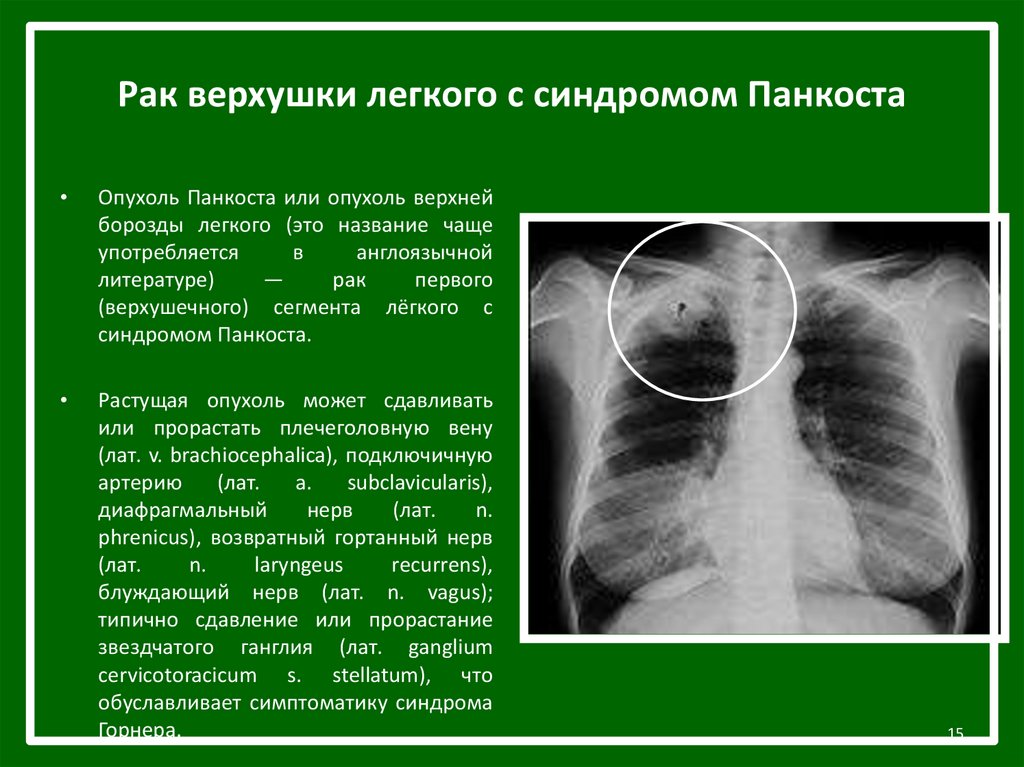 Заболевания левого легкого. Рентгенограмма опухоль легкого. Описание снимков легких. Опухоль лёгких на рентгене.