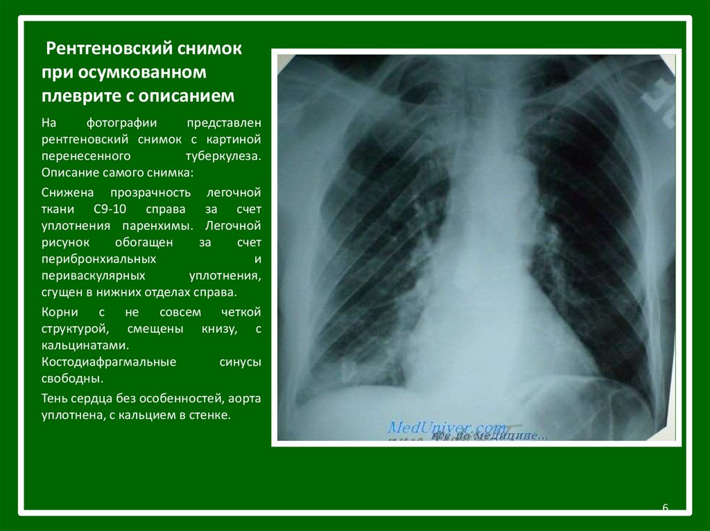 Что значит рентген. Парамедиастинальный плеврит рентген. Осумкованный плеврит справа рентген. Сухой плеврит рентген. Туберкулезный плеврит осумкованный рентген.