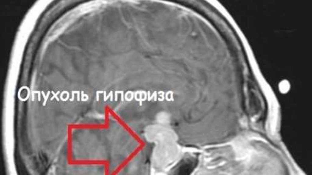 Опухоль гипофиза. Менингиома аденома гипофиза. Арахноидальная киста гипофиза. Киста гипофиза головного мозга.