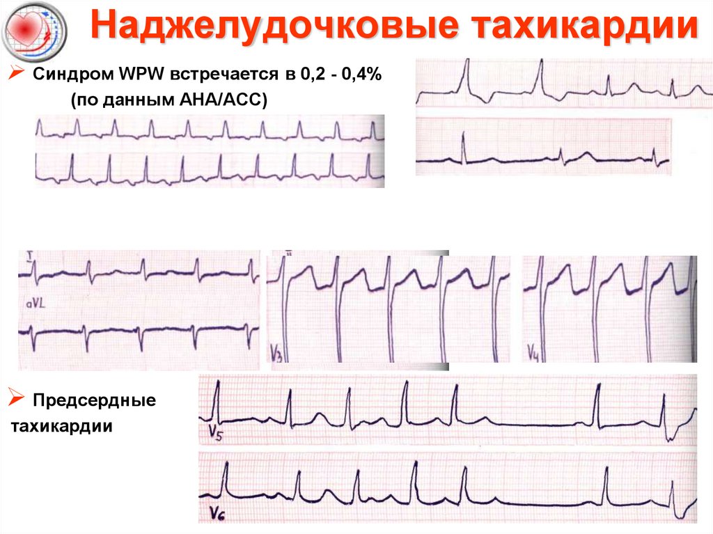 Тахикардия последствия