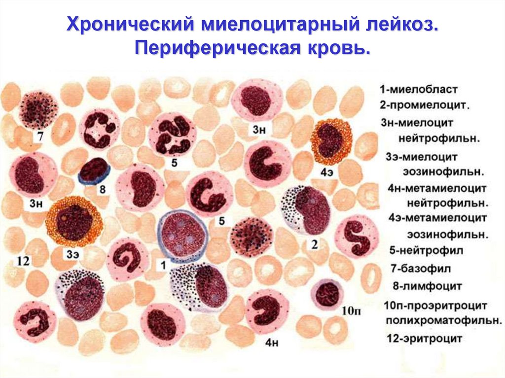 Миелоциты в костном мозге. Хронический миелолейкоз (ХМЛ) лейкоз. Хронический миелобластный лейкоз гистология. Картина крови хронического миелолейкоза. Миелоцитарный лейкоз картина крови.