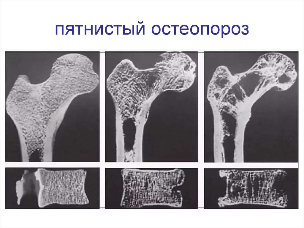Изменение структуры кости. Остеопороз перелом рентген. Болезнь Горхема Стаута. Остеопороз костей рентген. Кость с остеопорозом рентген.