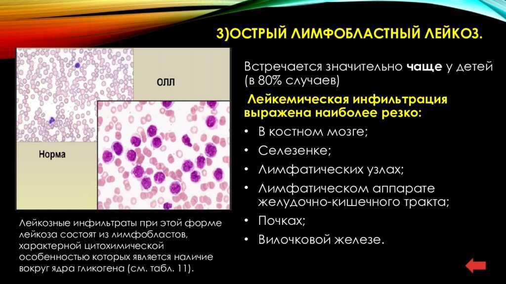 Причины лейкоза у детей. Острый лимфобластный лейкоз. Лимфобластный лейкоз в2 клеточный. Острый макро лимфобластный лейкоз. L2 лимфобластный лейкоз.