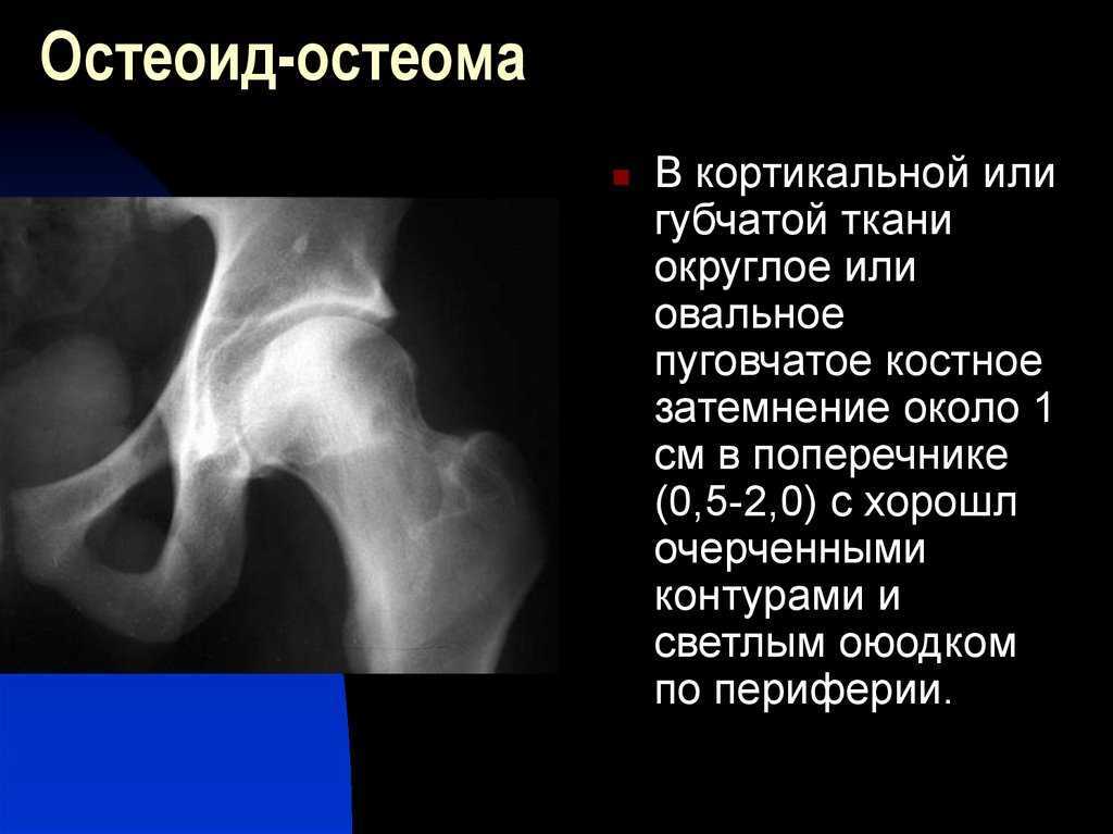 Остеома бедренной кости. Остеоид остеома ребра на кт. Остеоид-остеома костей таза рентген.