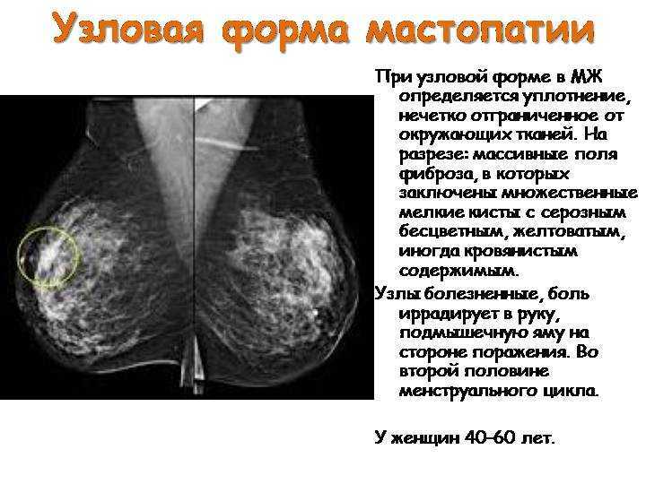 Заболевания правой молочной железы. Фиброзно кистозная мастопатия маммограмма. Узловая форма ФКМ молочной железы маммография. Диффузная мастопатия маммограмма. Узловая форма фиброзно-кистозной мастопатии на УЗИ.