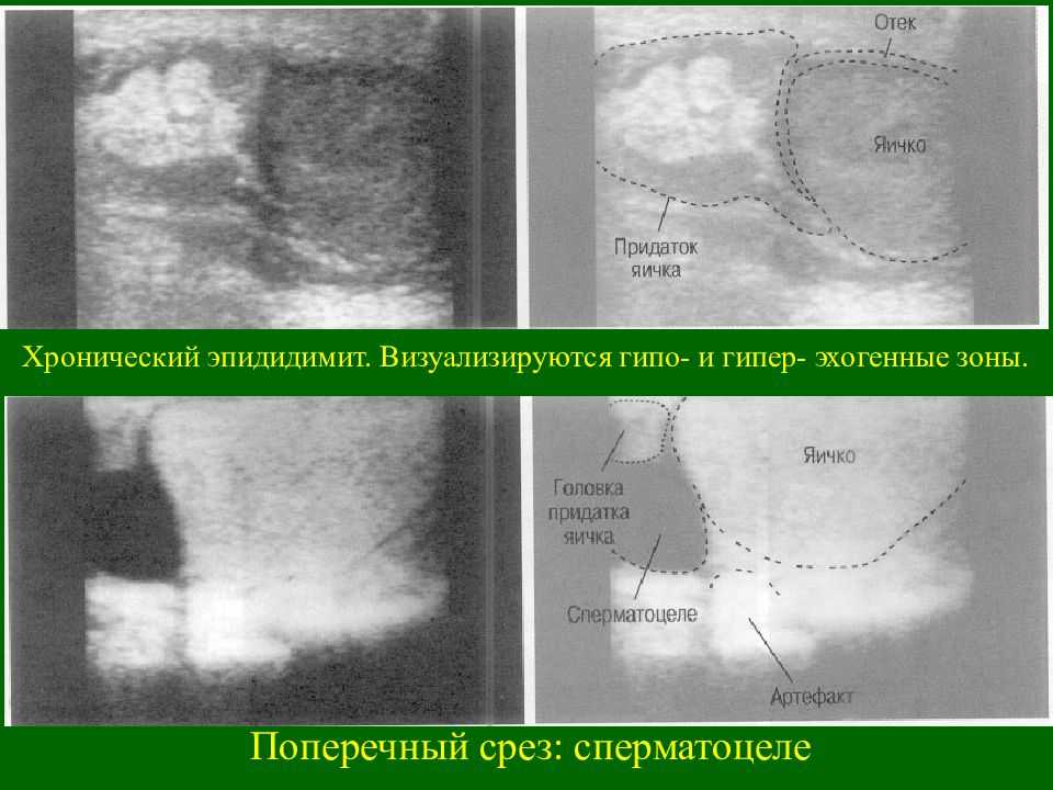 Придаток яичка у мужчин удаление. Воспаление придатка яичка – эпидидимит.. Воспаление придатка яичка на УЗИ. Эпидидимит УЗИ признаки. УЗИ мошонки эпидидимита.