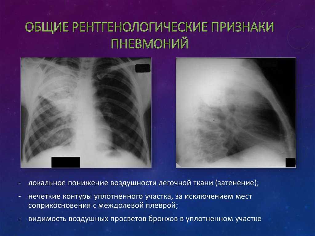 Признаки бронхита легких