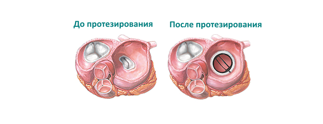Как клапан делает операция. Сердце операция митральный клапан. Операция на сердце аортальный клапан. Протез митрального клапана сердца. Протезирование клапанов сердца операция.