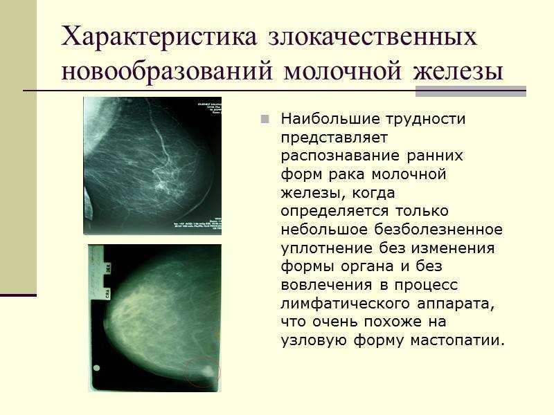 Опухоли молочных желез. Фиброаденома молочной железы исход. Злокачественное новообразование молочной железы. Злокачественное образование в молочной железе. Доброкачественная опухоль молочной железы.