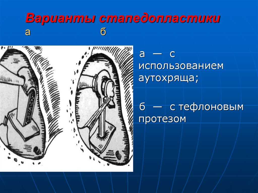 Стапедопластика. Стапедопластика операция. Поршневая стапедопластика. Тефлоновый протез стапедопластика.