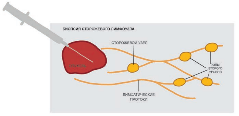 Биопсия при меланоме. Биопсия сигнального лимфатического узла. Показания для биопсии сторожевого лимфатического узла. Биопсия лимфатических узлов при РМЖ.