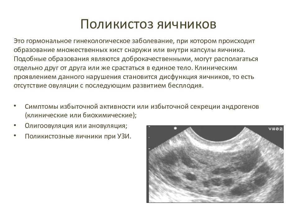 Поликистоз симптомы. Синдром поликистозных яичников УЗИ. Синдром поликистоза яичников на УЗИ. Ультразвуковые критерии поликистозных яичников. Мультифолликулярные яичники на УЗИ.