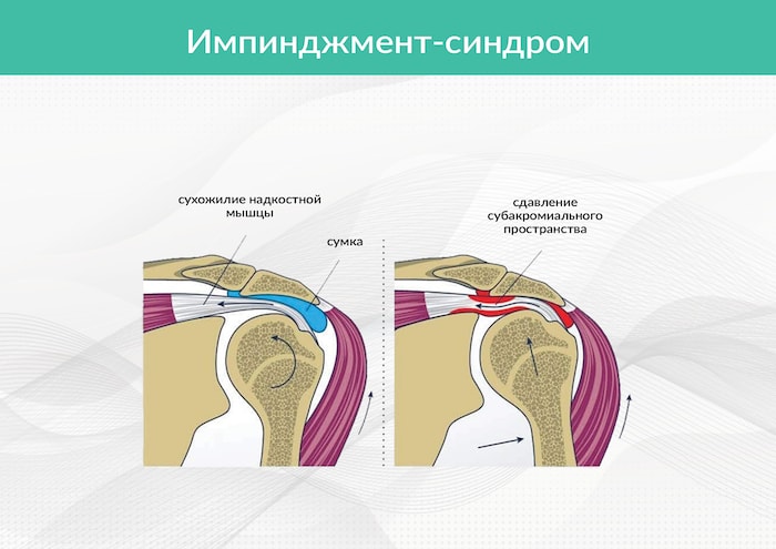 Как лечить периартрит плечевого сустава. Плече-лопаточный синдром. Плечелопаточный периартроз мкб 10. Плече-лопаточная периартрит. Синдром плечелопаточный периартрит.